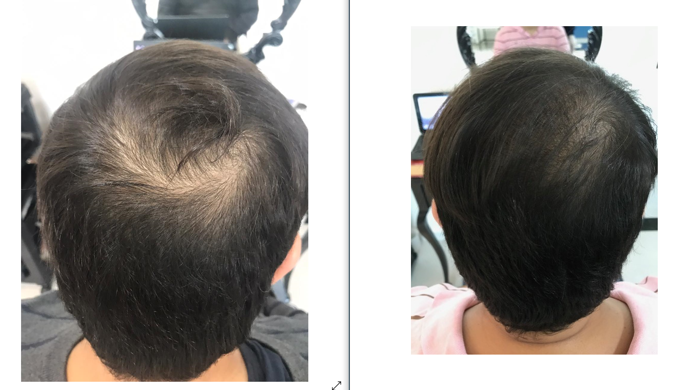 Resultado 7, Protocolo M Hair