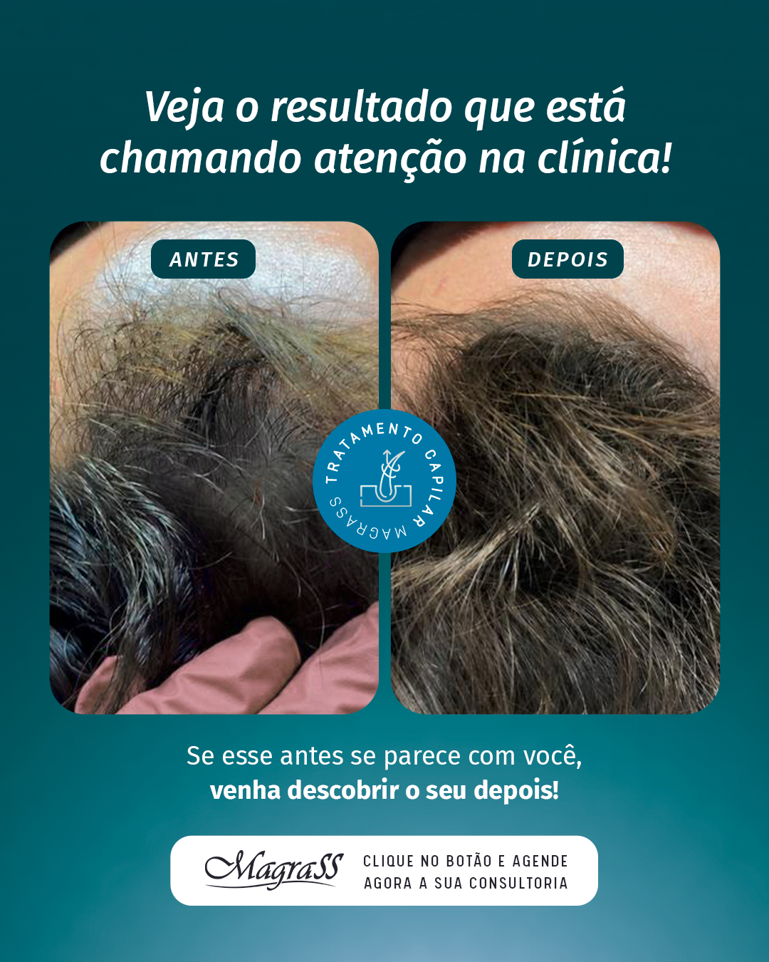 Resultado 2, Protocolo M Hair