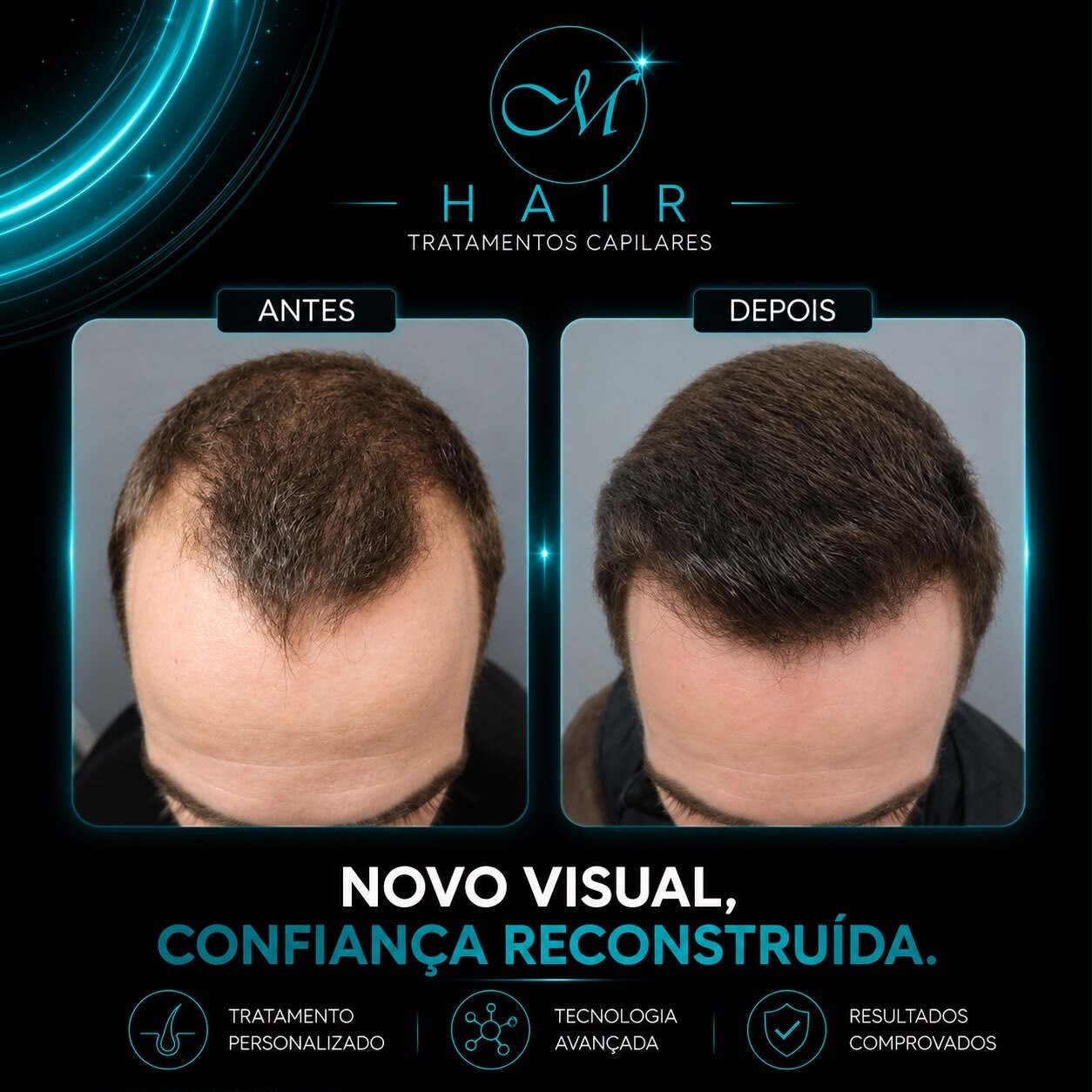 Resultado 4, Protocolo M Hair